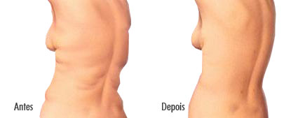 Lipo em Curitiba